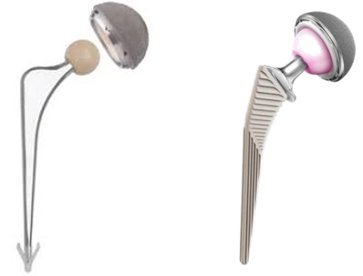 Right: ceramic femoral head; Left: cemented hip replacement