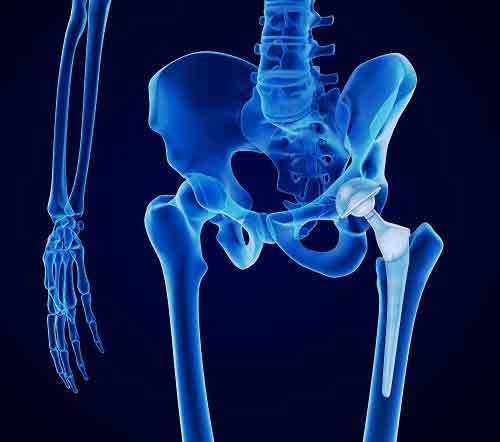 How Are Hip Replacements Made?