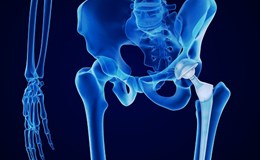 How Are Hip Replacements Made?