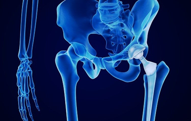How Are Hip Replacements Made?
