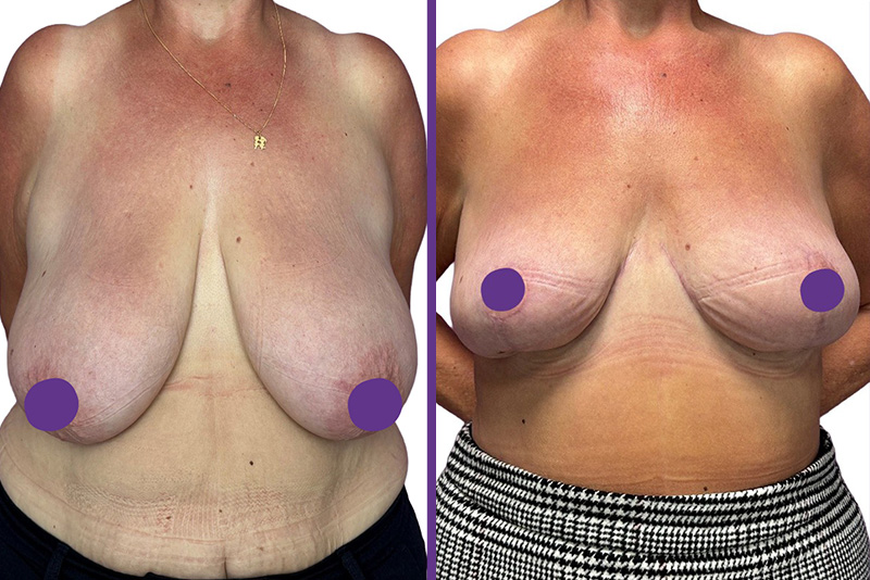 Josie's breast reduction surgery