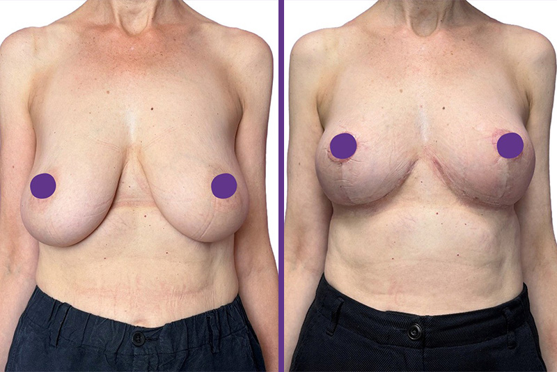 Breast reduction surgery