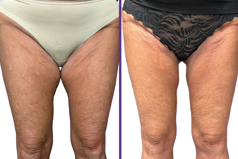 Julie's thigh lift surgery