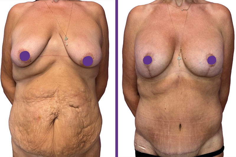 Rachel's excess skin removal