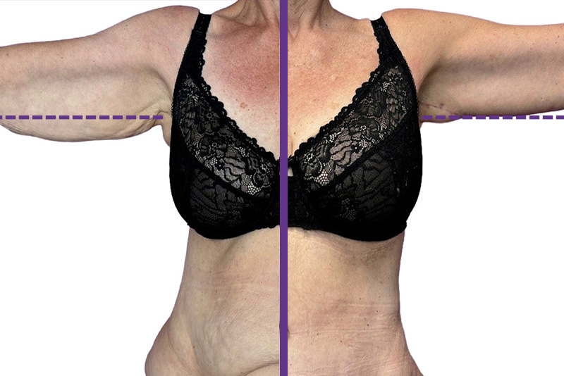 Dawn's excess skin removal