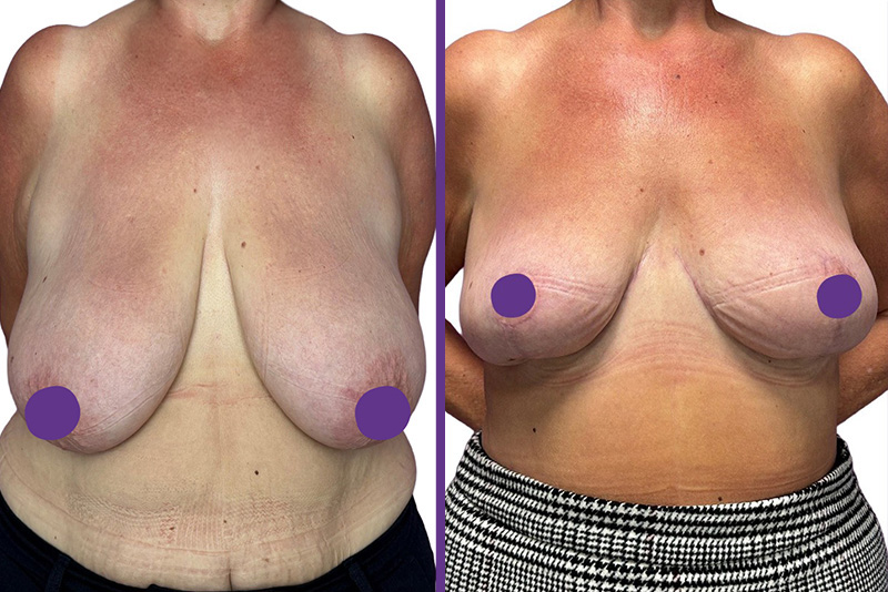 Breast reduction surgery